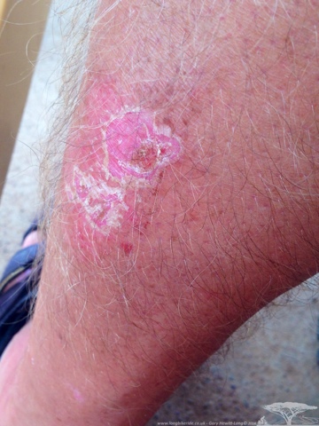 Healing Nicely after touching a Moto Exhaust pipe.